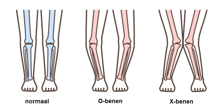 grafische weergave van X-benen en O-benen