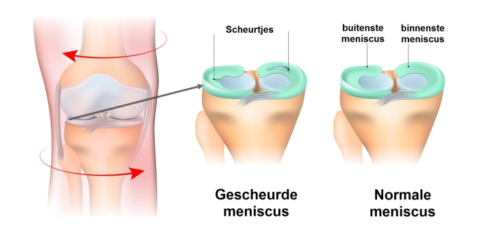 Grafische weergave gescheurde meniscus