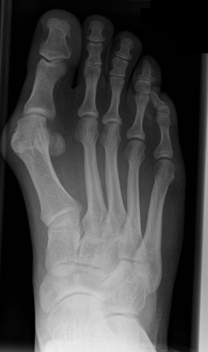 Röntgenfoto van een voet met hallux valgus.