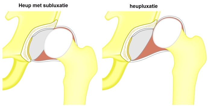 Grafische weergave van een heup met subluxatie en een heupluxatie. 
