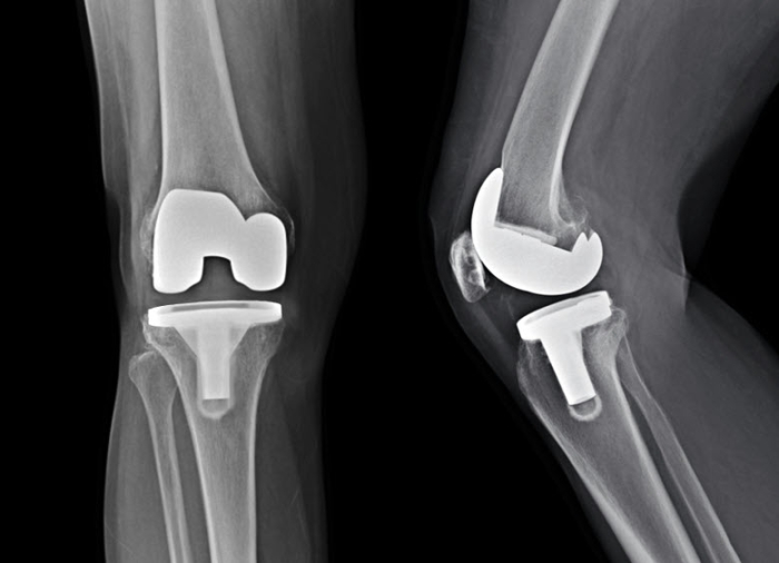 Röntgenfoto met knieprothese in voor- en zij-aanzicht