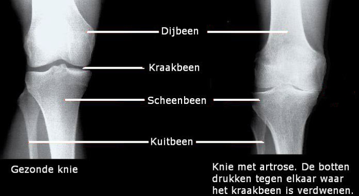 Röntgenfoto van gezonde knie en knie met artrose.