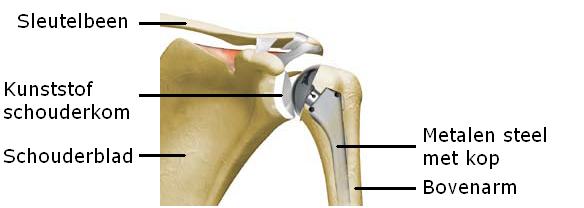 Schouderprothese - Slingeland Ziekenhuis